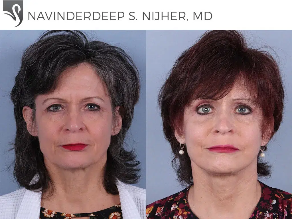 Before and After Image: Face Lift Case #73993 - front