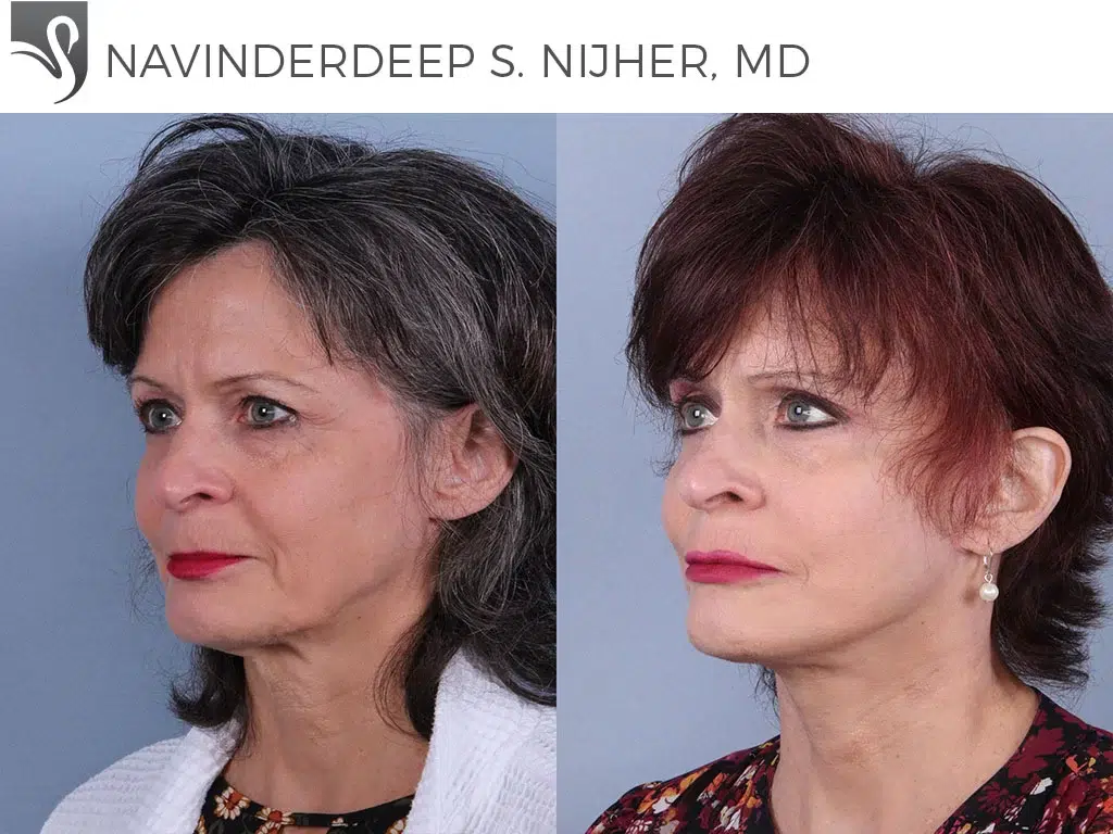 Before and After Image: Face Lift Case #73993 - left-front-oblique