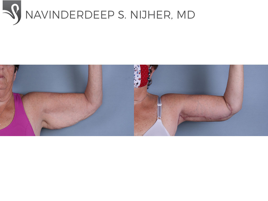 Before and After Image: Arm Lift Case #67658