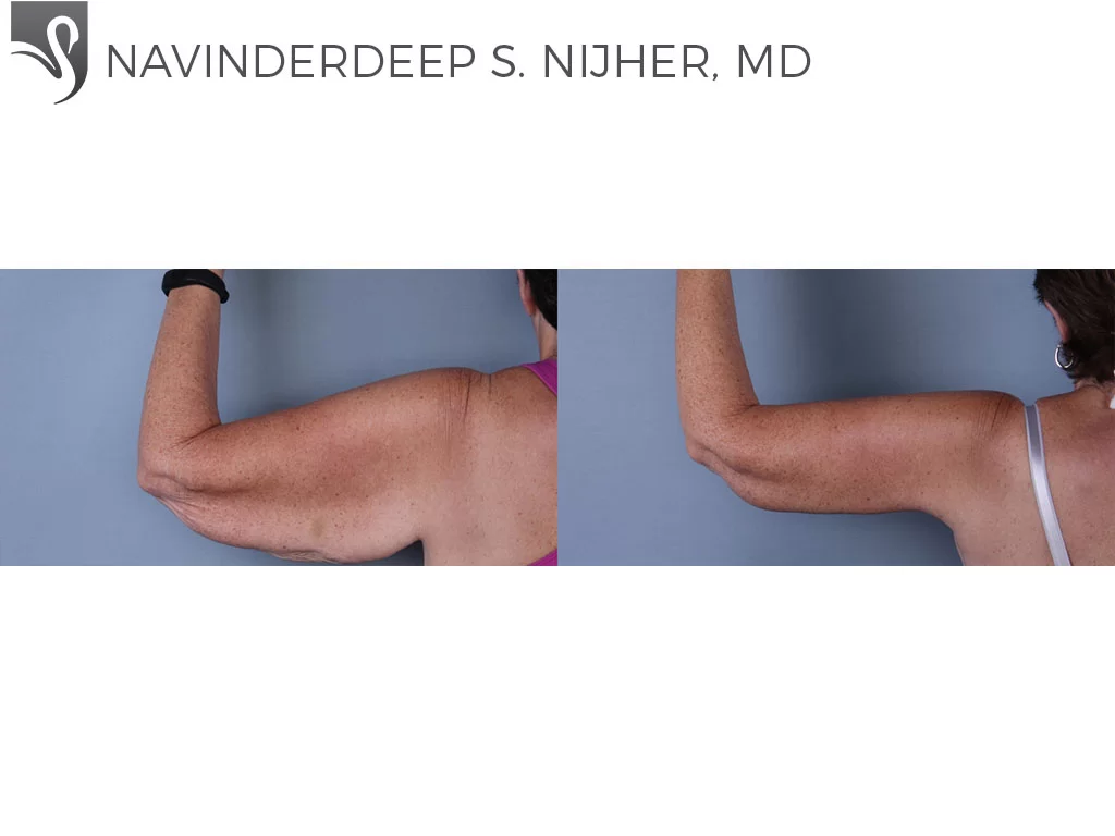 Before and After Image: Arm Lift Case #67658 - back