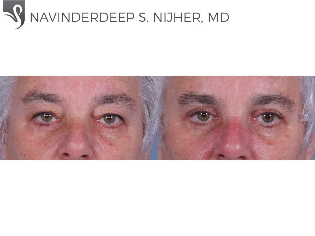 Before and After Image: Eyelid Surgery Case #67847 - front