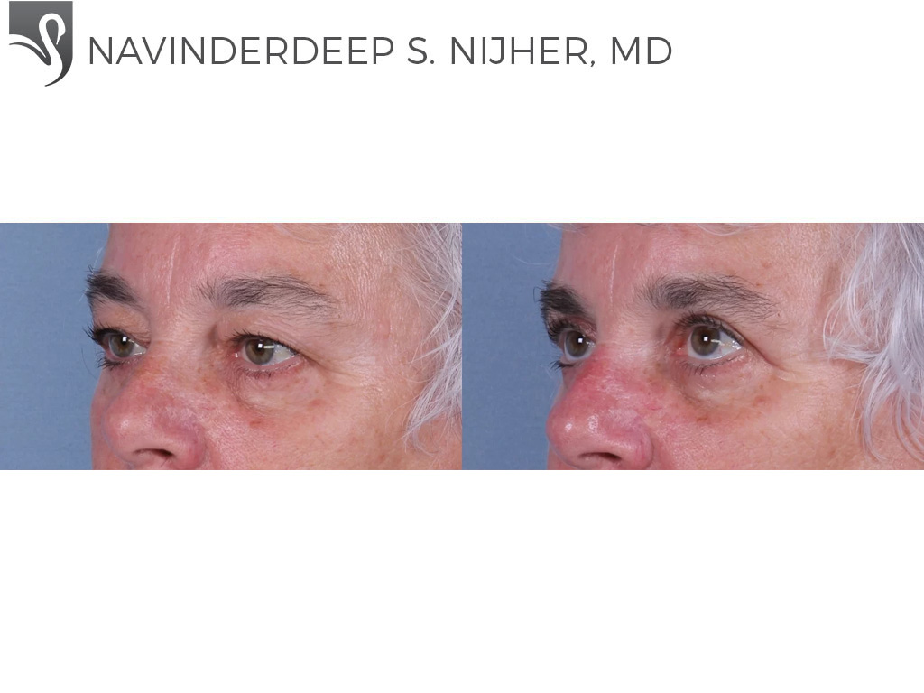 Before and After Image: Eyelid Surgery Case #67847 - left-front-oblique