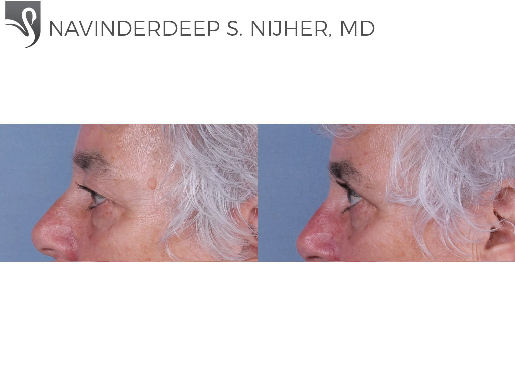 Before and After Image: Eyelid Surgery Case #67847 - left-side