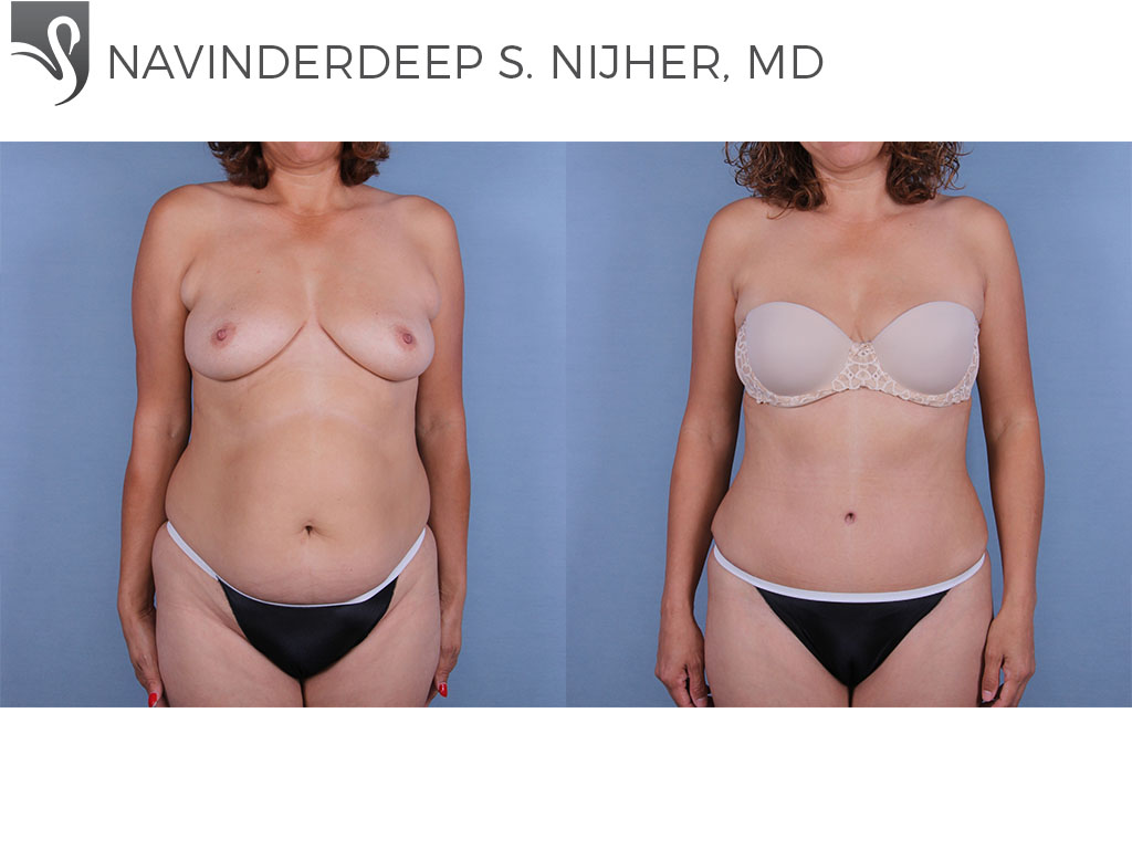 Before and After Image: Abdominoplasty (Tummy Tuck) Case #68230 - front