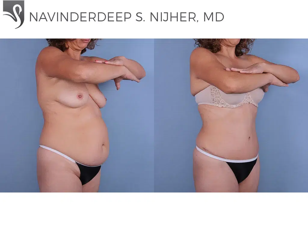 Before and After Image: Abdominoplasty (Tummy Tuck) Case #68230 - right-front-oblique