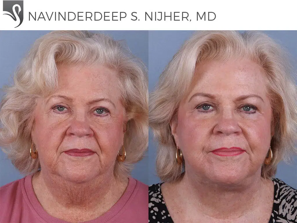 Before and After Image: Face Lift Case #68351 - front