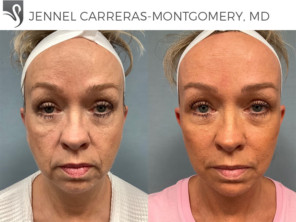 Before and After Image: Face Lift Case #68410 - front