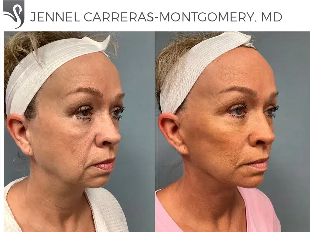 Before and After Image: Face Lift Case #68410 - right-front-oblique
