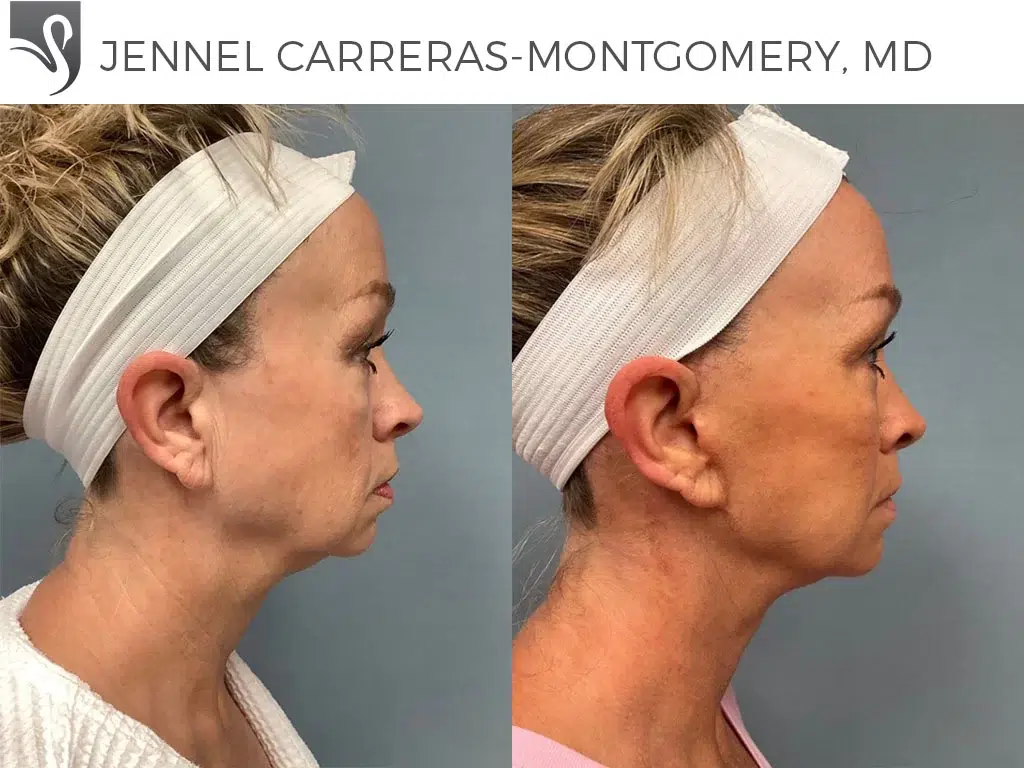 Before and After Image: Face Lift Case #68410 - right-side