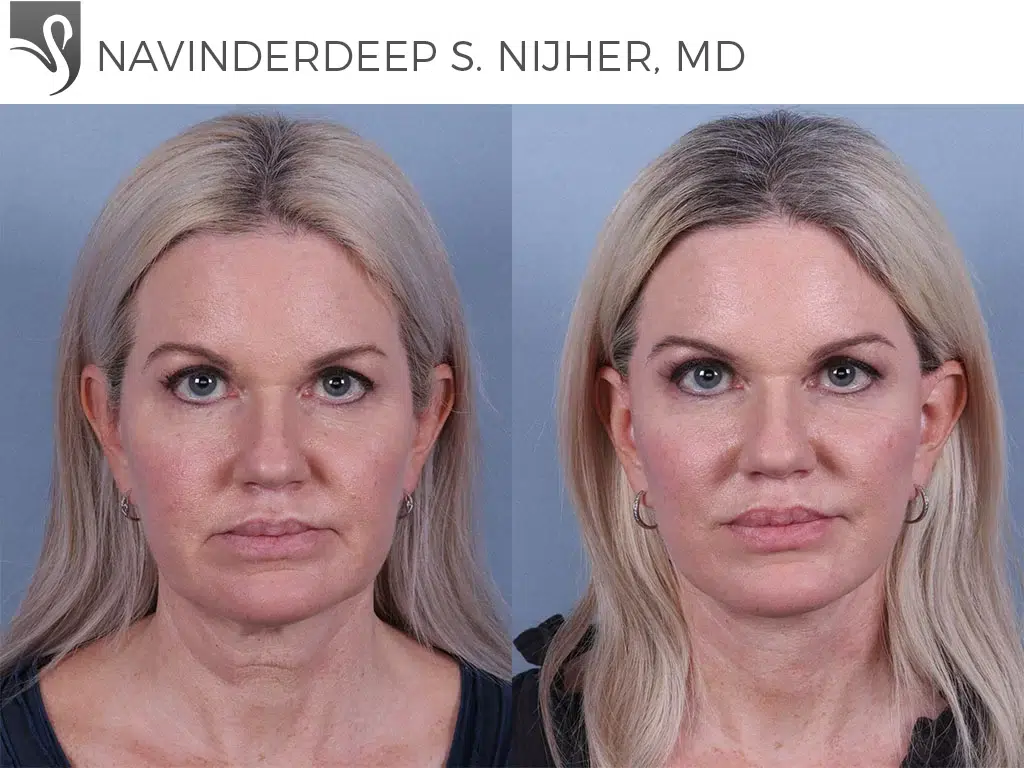 Before and After Image: Face Lift Case #68655 - front