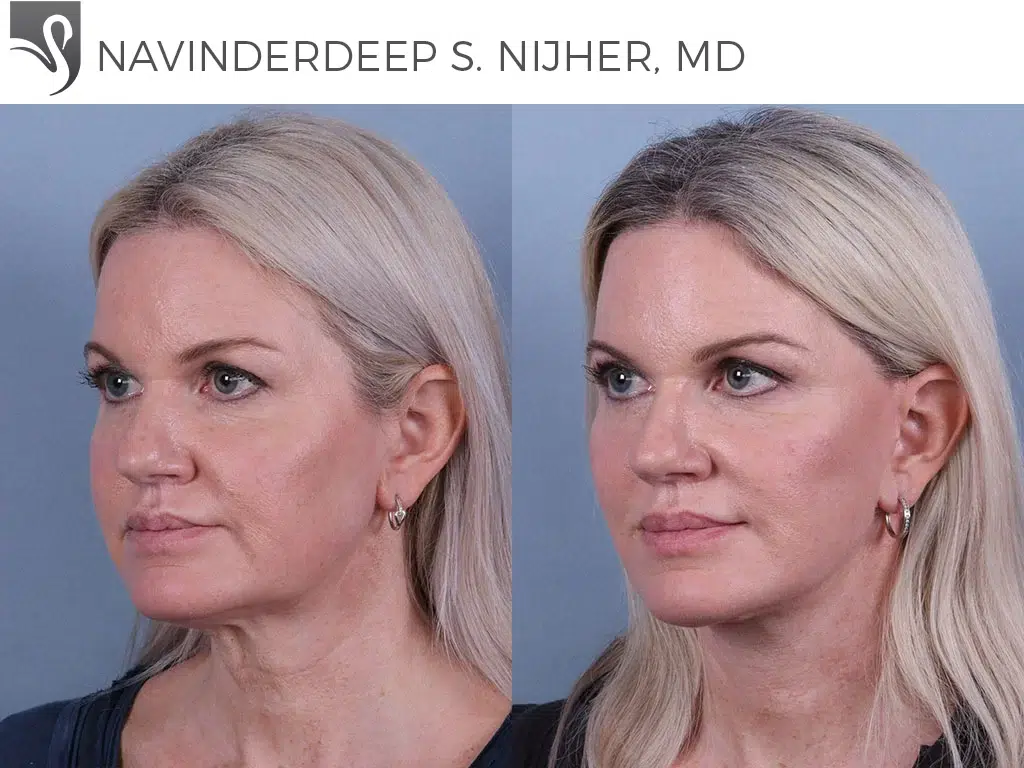 Before and After Image: Face Lift Case #68655 - left-front-oblique