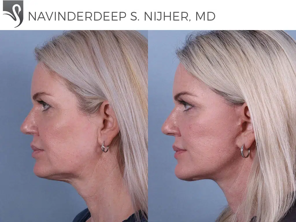 Before and After Image: Face Lift Case #68655 - left-side