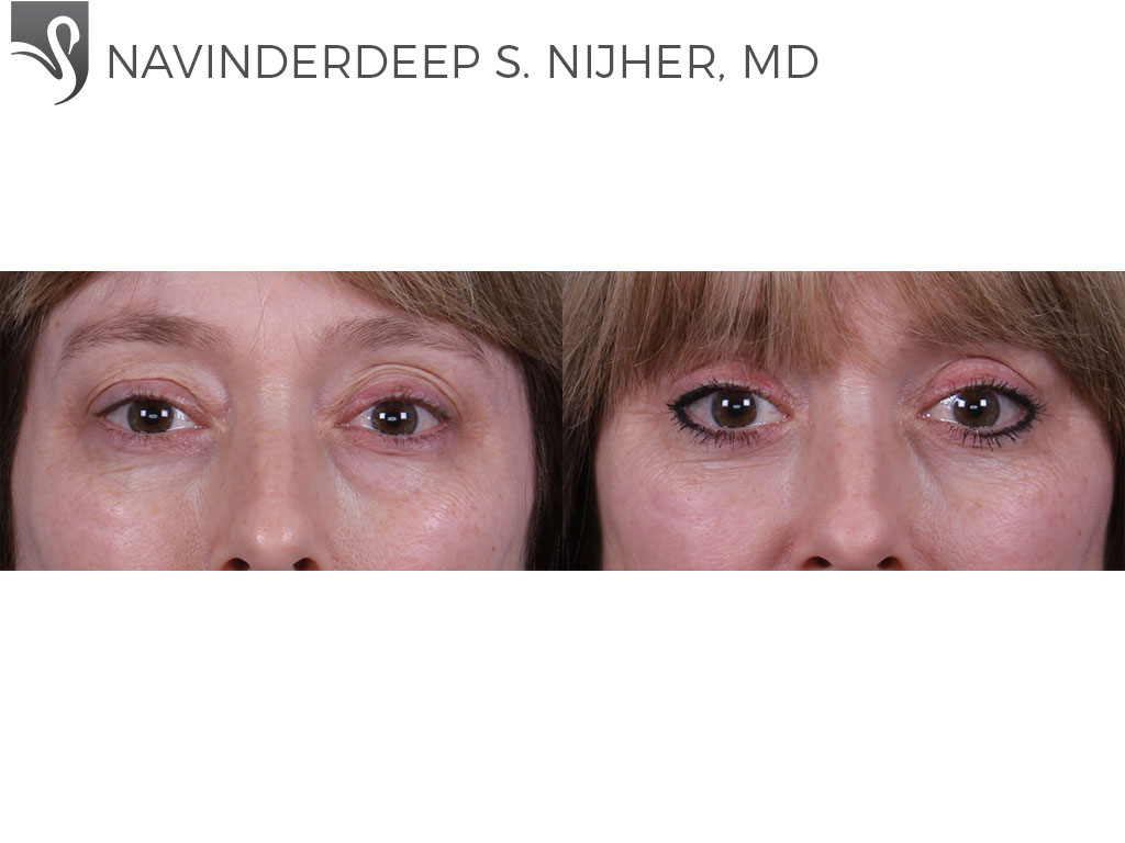 Before and After Image: Eyelid Surgery Case #68687 - front