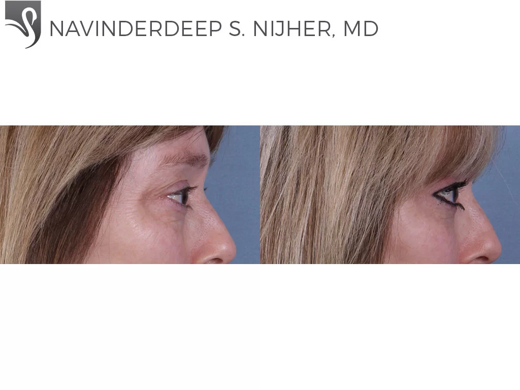 Before and After Image: Eyelid Surgery Case #68687 - right-side