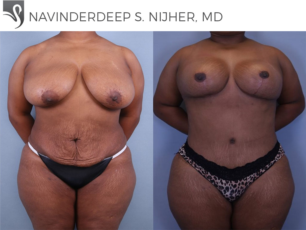 Before and After Image: Mommy Makeover Case #68742 - front