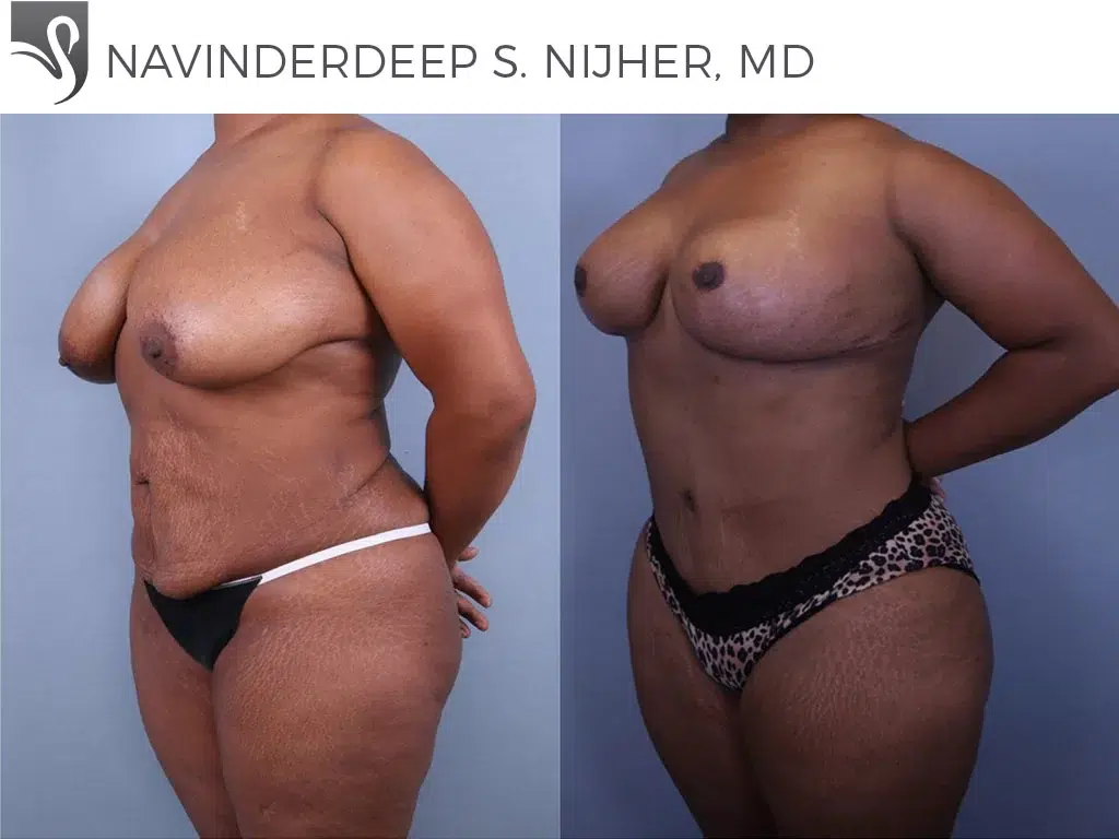 Before and After Image: Mommy Makeover Case #68742 - left-front-oblique