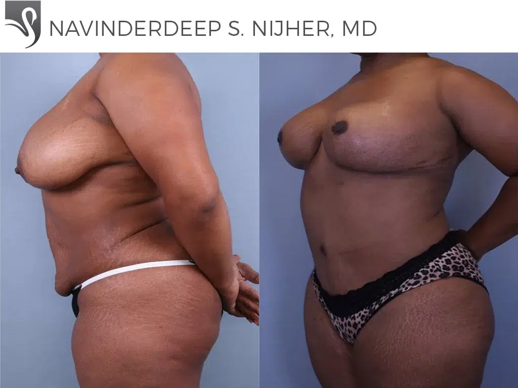 Before and After Image: Mommy Makeover Case #68742 - left-side