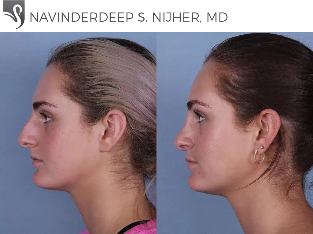 Before and After Image: Rhinoplasty Case #68777