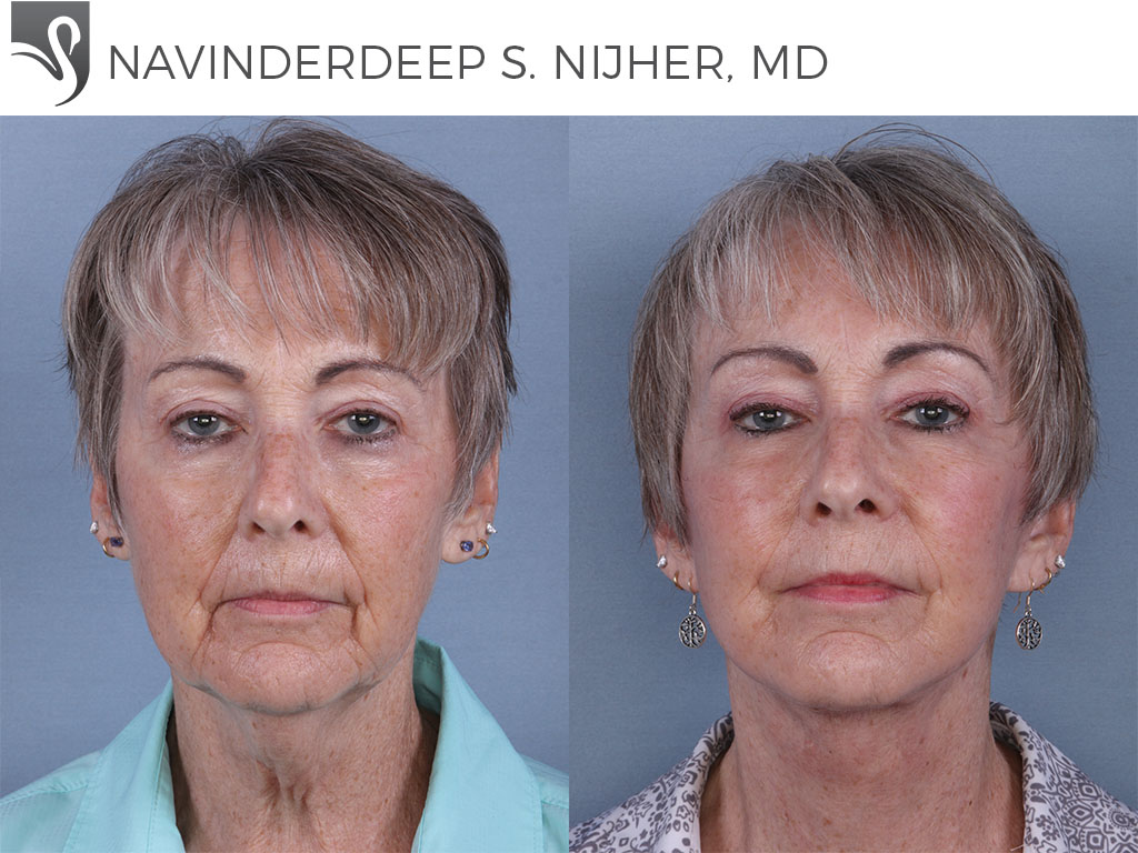 Before and After Image: Face Lift Case #68998 - front