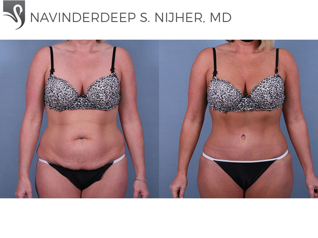 Before and After Image: Abdominoplasty (Tummy Tuck) Case #69015 - front