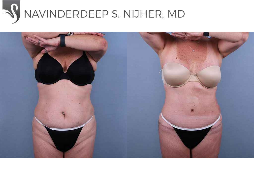 Before and After Image: Abdominoplasty (Tummy Tuck) Case #69241 - front