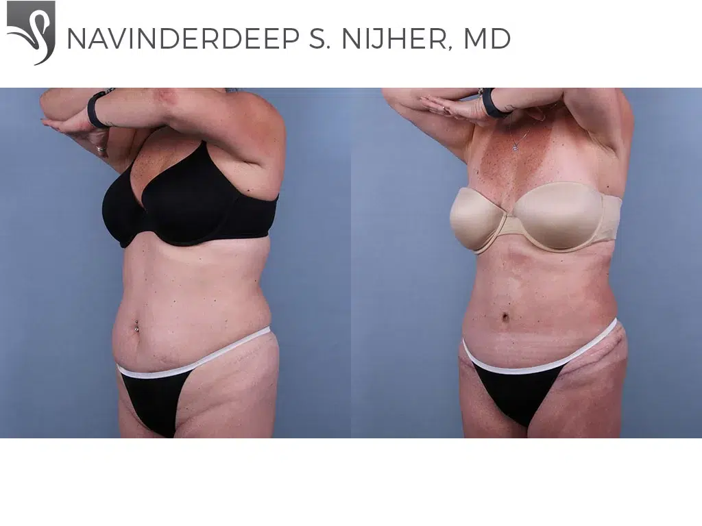 Before and After Image: Abdominoplasty (Tummy Tuck) Case #69241 - left-front-oblique