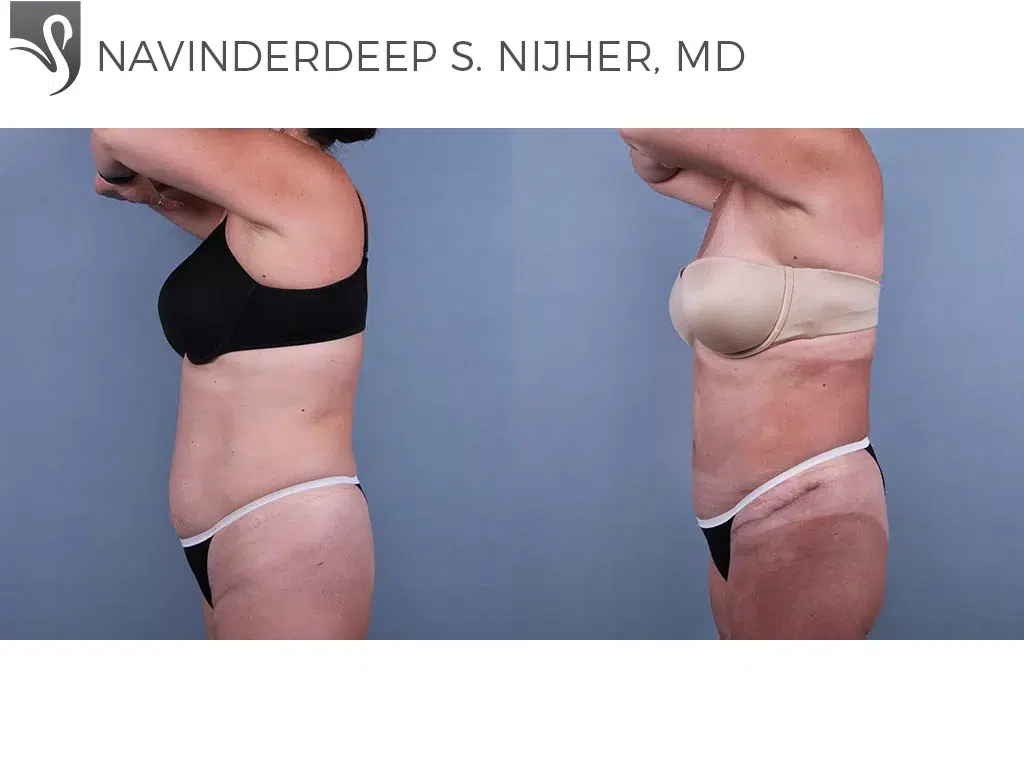 Before and After Image: Abdominoplasty (Tummy Tuck) Case #69241 - left-side