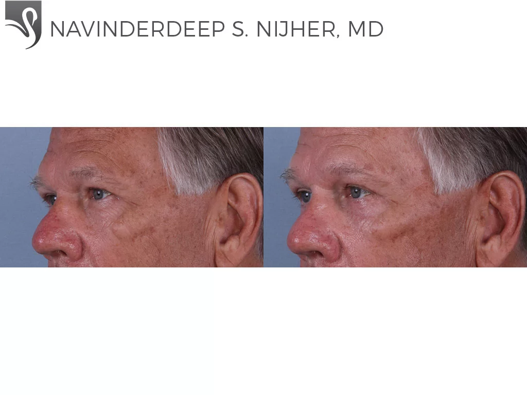 Before and After Image: Eyelid Surgery Case #69282 - left-front-oblique