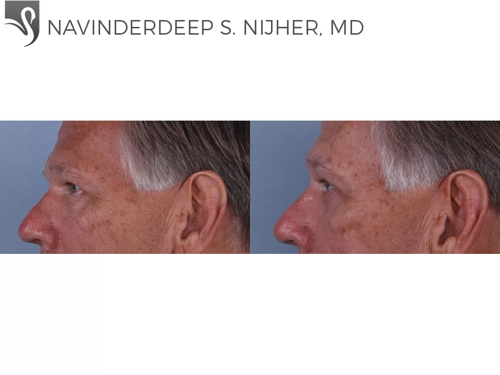 Before and After Image: Eyelid Surgery Case #69282 - left-side