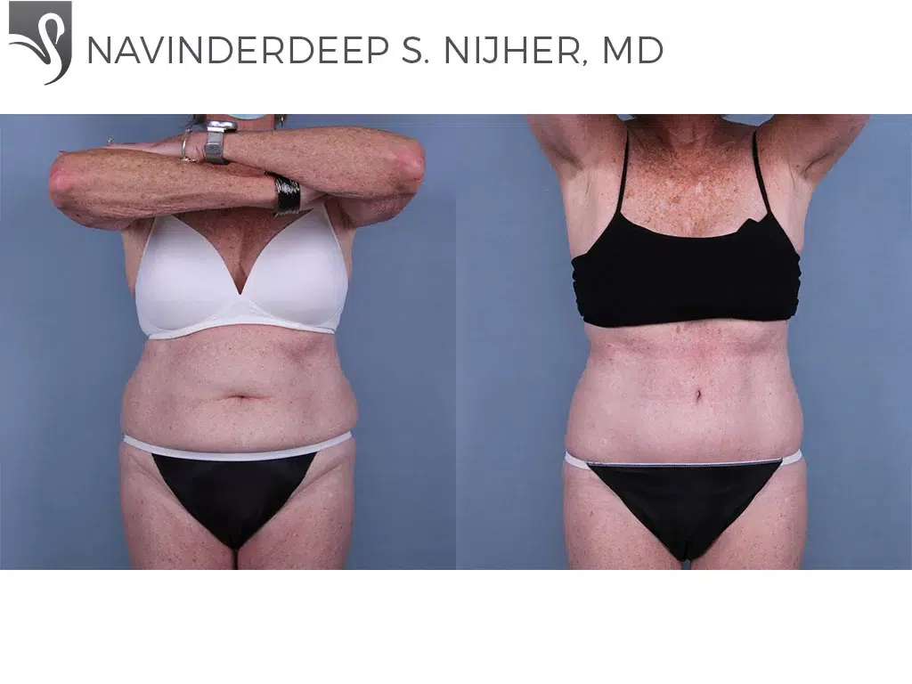 Before and After Image: Abdominoplasty (Tummy Tuck) Case #69320 - front