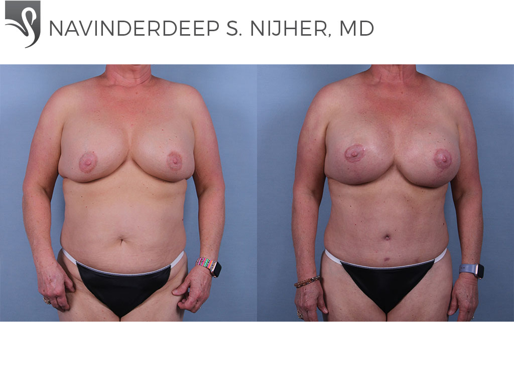 Before and After Image: Abdominoplasty (Tummy Tuck) Case #69573 - front