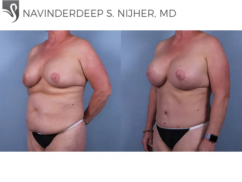 Before and After Image: Abdominoplasty (Tummy Tuck) Case #69573 - left-front-oblique
