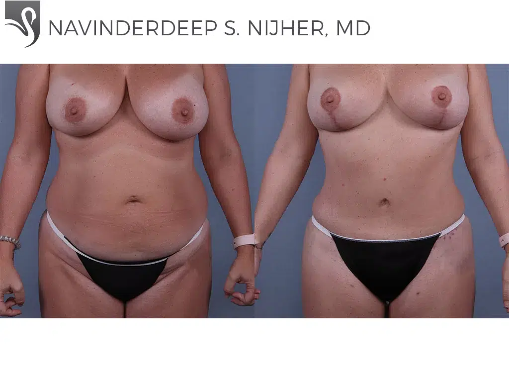 Before and After Image: Abdominoplasty (Tummy Tuck) Case #69812 - front
