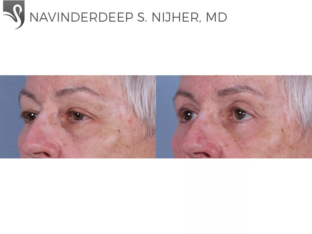 Before and After Image: Eyelid Surgery Case #69842 - left-front-oblique