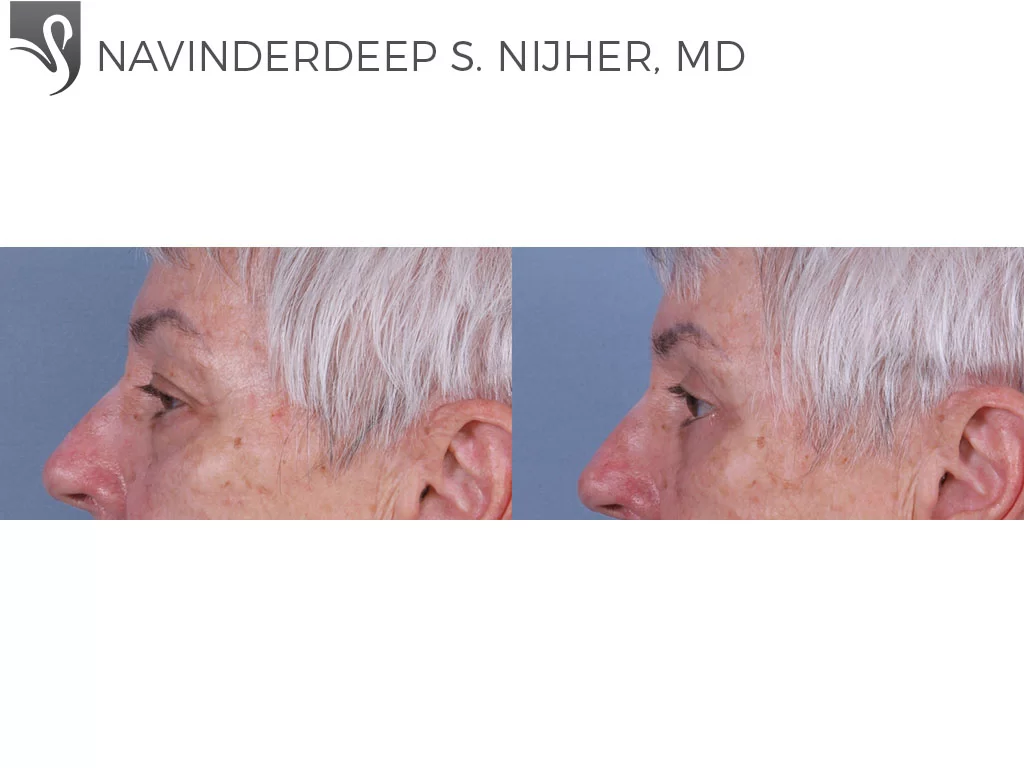 Before and After Image: Eyelid Surgery Case #69842 - left-side