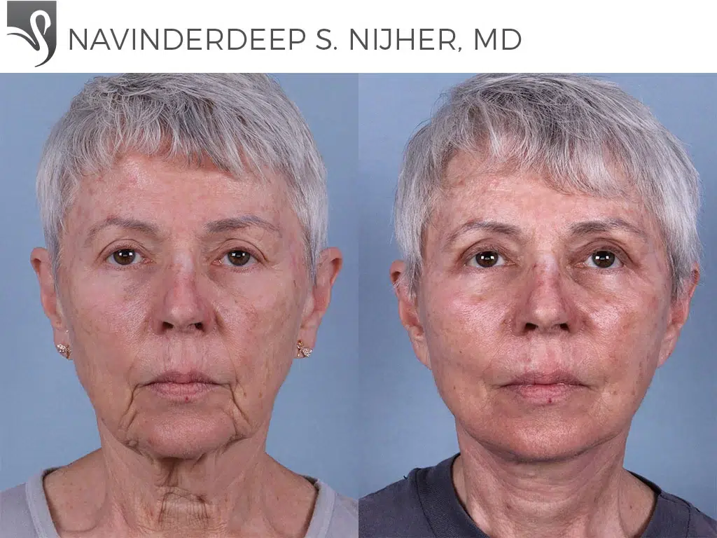 Before and After Image: Face Lift Case #69842