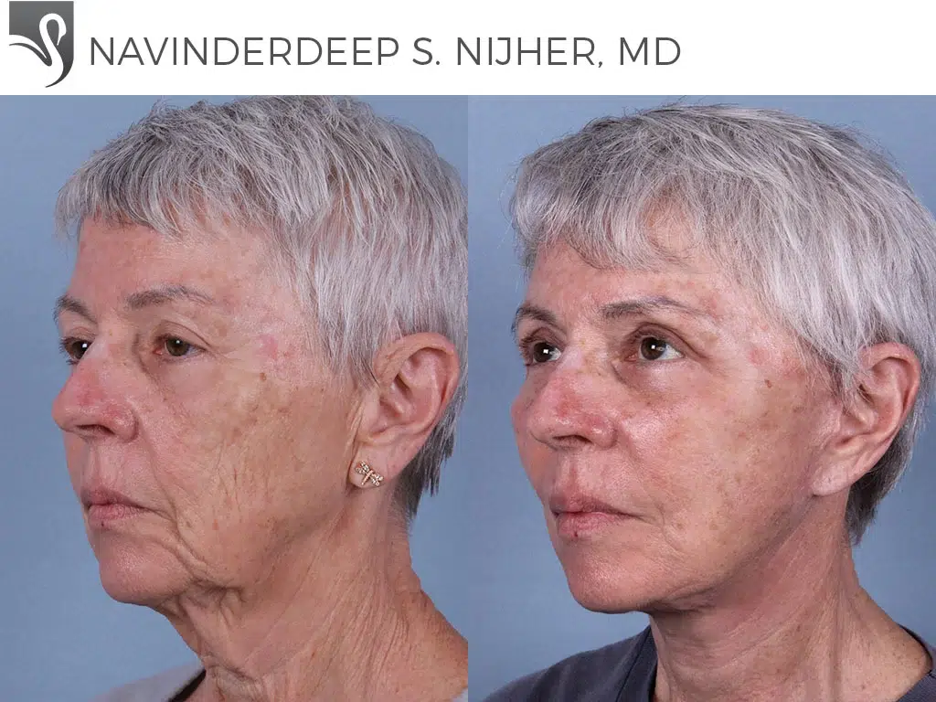 Before and After Image: Face Lift Case #69842 - left-front-oblique