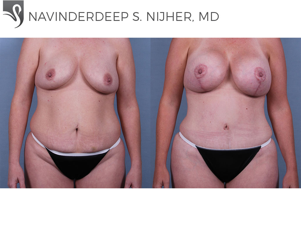 Before and After Image: Abdominoplasty (Tummy Tuck) Case #69898 - front