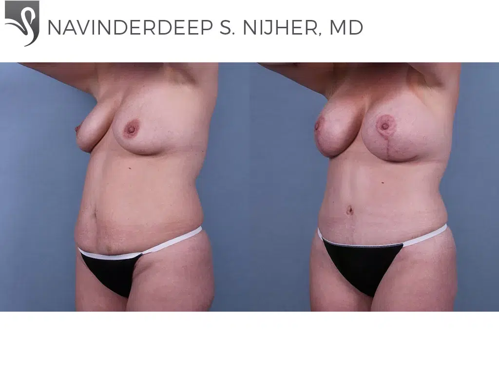 Before and After Image: Abdominoplasty (Tummy Tuck) Case #69898 - left-front-oblique