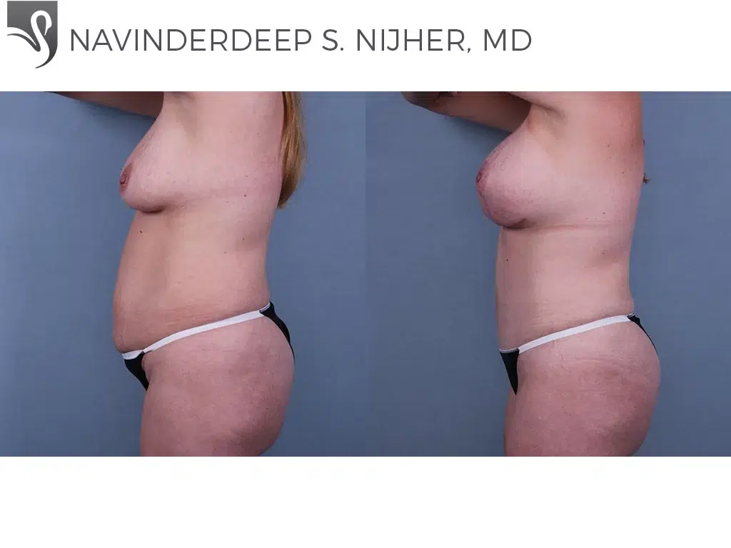 Before and After Image: Abdominoplasty (Tummy Tuck) Case #69898 - left-side