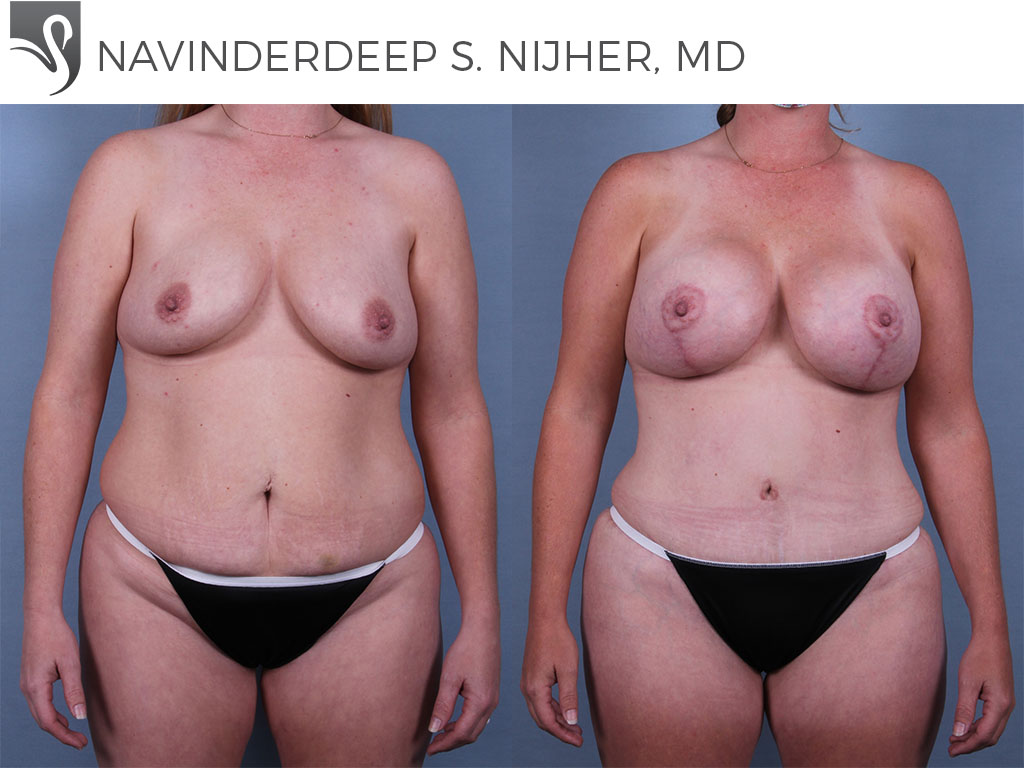 Before and After Image: Mommy Makeover Case #69898 - front