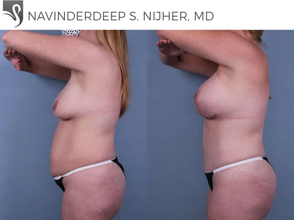 Before and After Image: Mommy Makeover Case #69898 - left-side