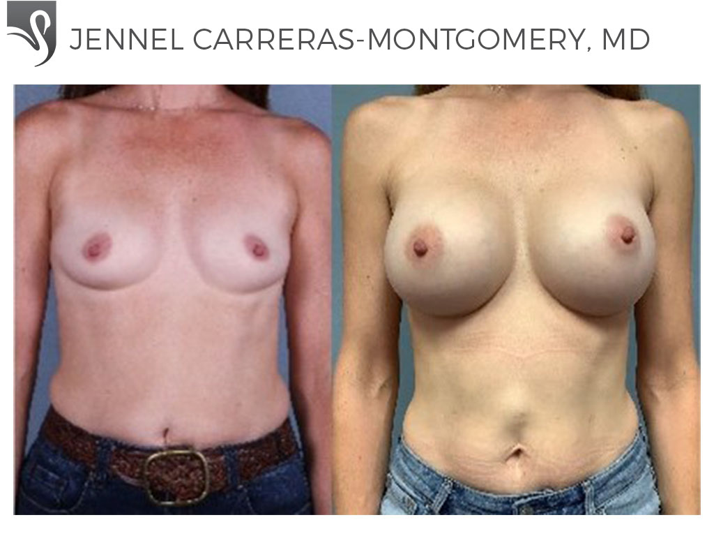 Before and After Image: Breast Augmentation Case #69994 - front