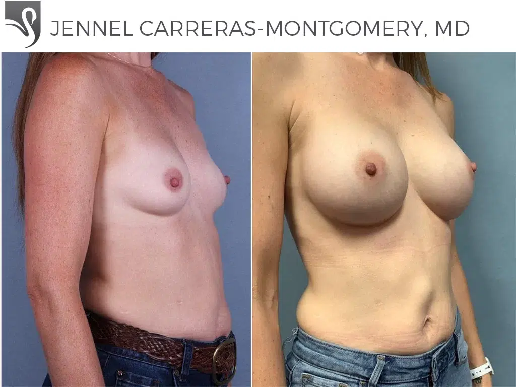 Before and After Image: Breast Augmentation Case #69994 - right-front-oblique