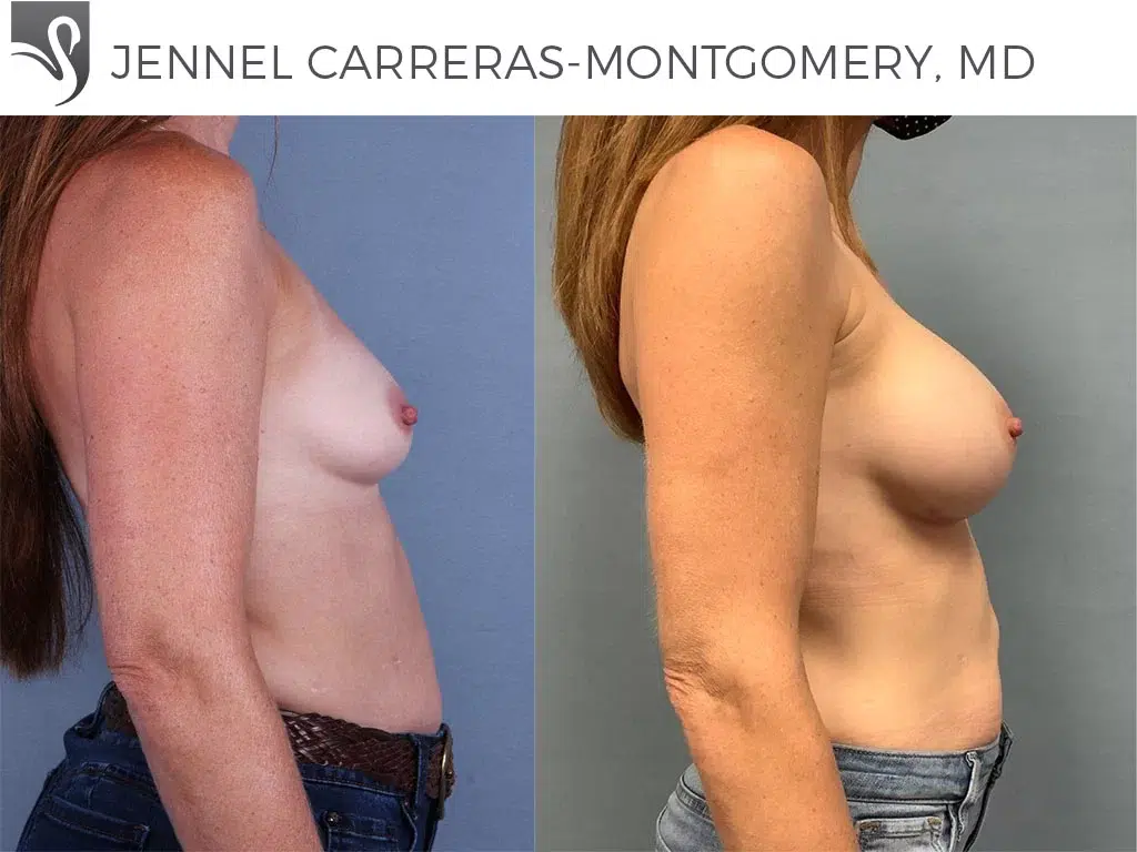 Before and After Image: Breast Augmentation Case #69994 - right-side