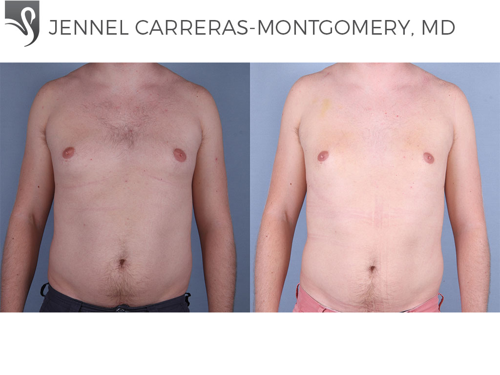 Before and After Image: Male Breast Reduction Case #70040 - front
