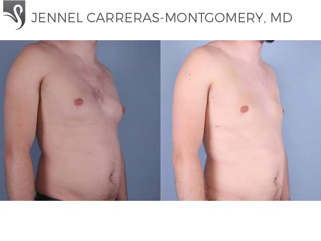 Before and After Image: Male Breast Reduction Case #70040 - right-front-oblique