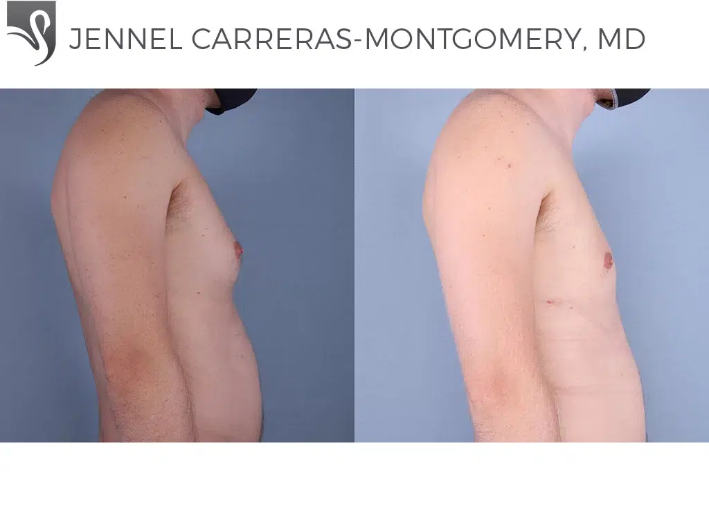Before and After Image: Male Breast Reduction Case #70040 - right-side