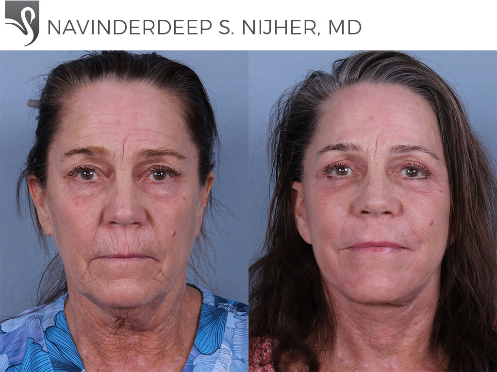 Before and After Image: Face Lift Case #70168 - front