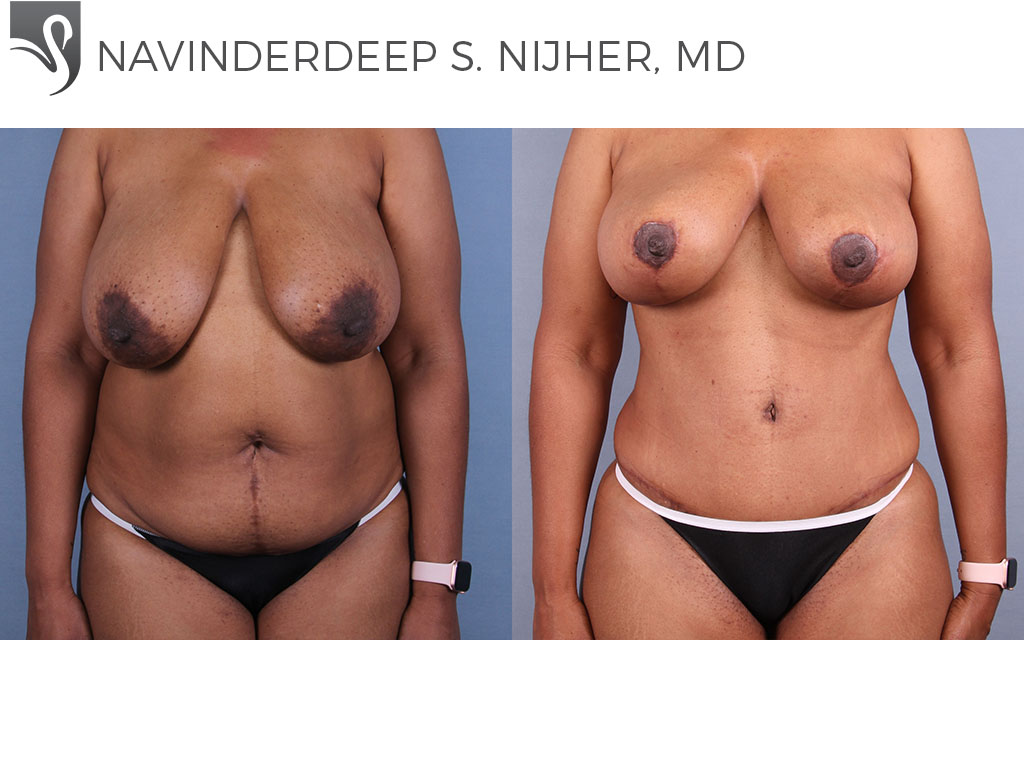 Before and After Image: Abdominoplasty (Tummy Tuck) Case #70212 - front